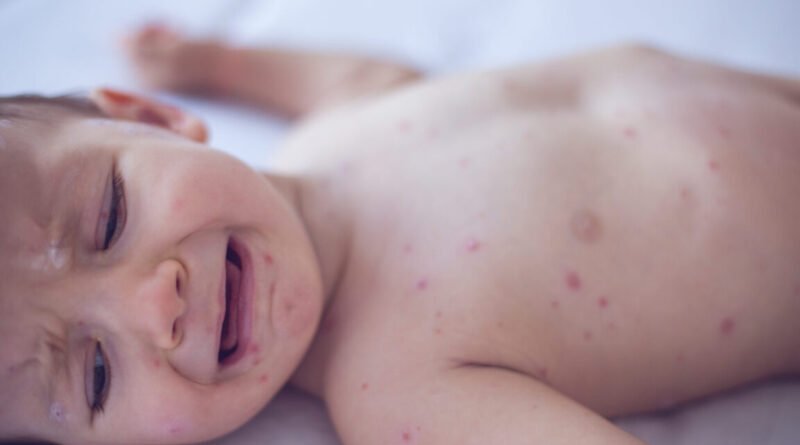 Coroner Confirms Measles Death in 6 Week Old Baby - SeeUY News